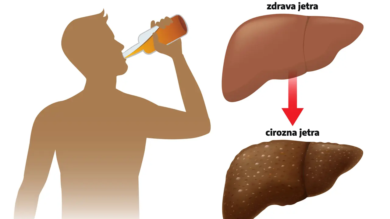 Alkoholna bolest jetre - ALD - Doktor More Srbija - PharmOcean Lab